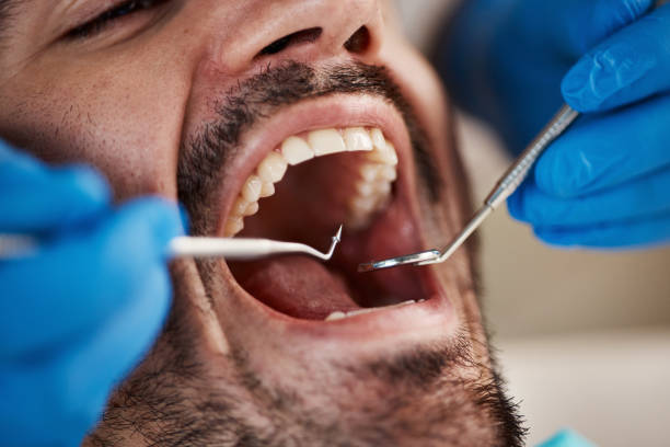 Best Emergency Root Canal Treatment in Sudley, VA